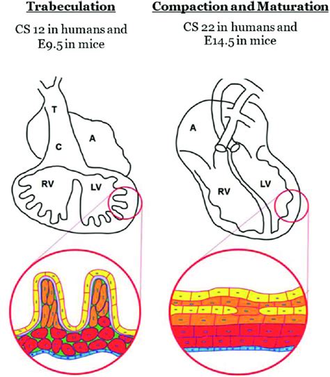 lv trabeculation and false cord|excessive trabeculation of left ventricle.